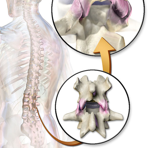 Facet Replacement Florida Spine Institute