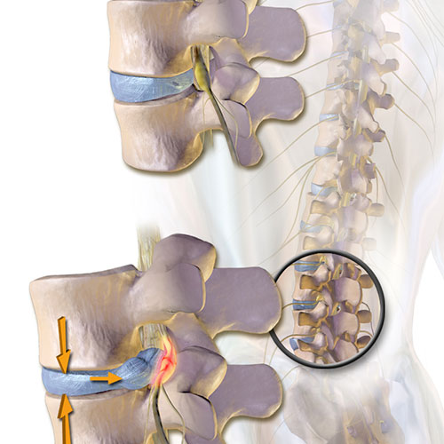 Suffering From a Herniated Disc? - Huffman Spine Clinic - Lumbar Disc  Herniation