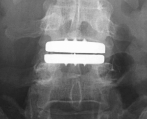 Artificial Disc Replacement - XRay of spine with disc